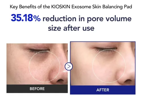 Pads Exfoliantes Ácido Salicílico Cuidado Poros 70 Todo Tipo De Piel Día/noche