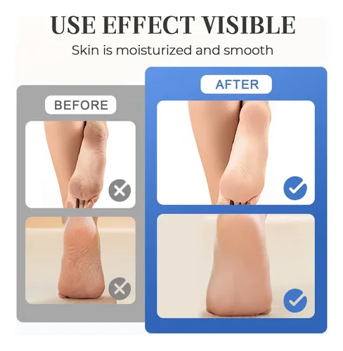 Crema Hidratante Para El Cuidado De Los Pies, Pomada Agrieta