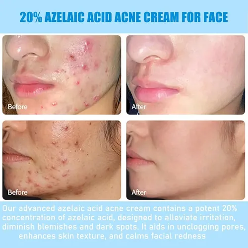 Crema Facial Para Acné Con 20% De Ácido Azelaico, Sérum De Á