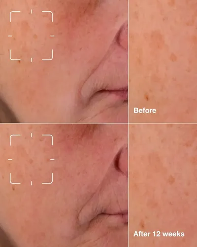 Suero Facial Even Better Clinical Dark Spot Clearing Serum