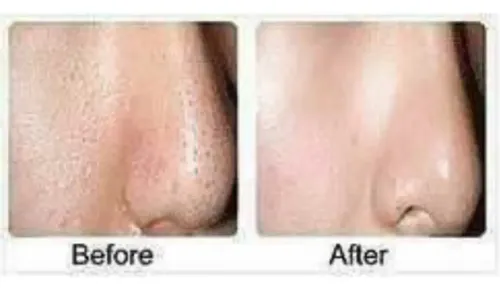 Ácido Salicilico,crema,serum O Solución.acne Y Piel Seborrei