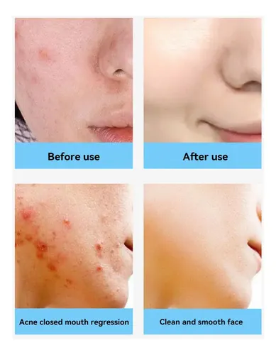 Crema De Tratamiento Antiacné Con Ácido Salicílico Para El A
