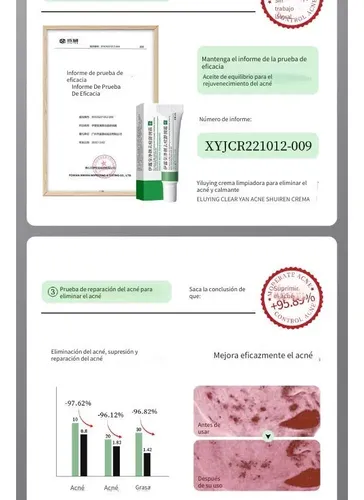 Wzk Crema Antiacné For Piel Grasa 20g Ebug Todo Tipo De Q