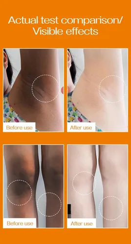 Crema Para Manchas Oscuras En La Cara, Crema Para Manchas Fa Todo Tipo De Piel Día/noche