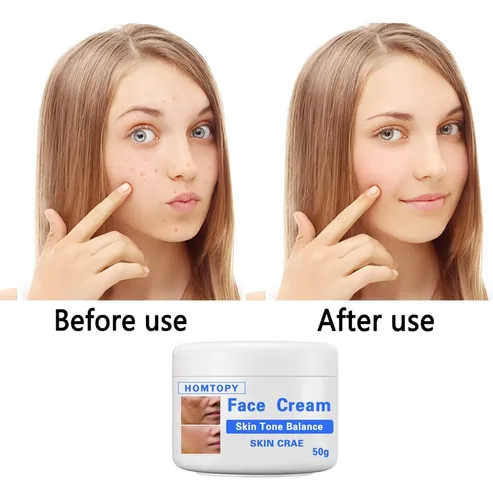 Crema Iluminadora Única Para Manchas Faciales, 50 G, Melasma