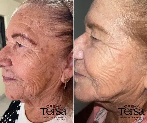 Mzcrema Tersa Despigmentante Quita Manchas Acné Paño De 40gm