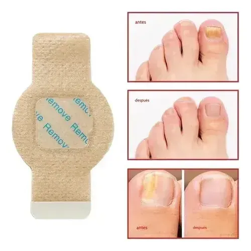 Parches Para Uñas Jf Fungal, 63 Unidades
