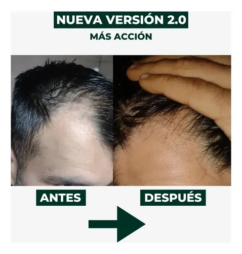 Combo Skinfinity X2 Serum Tratamiento Capilar
