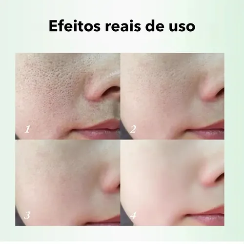 / Crema De Ácido Salicílico Para Eliminar Los Poros Del
