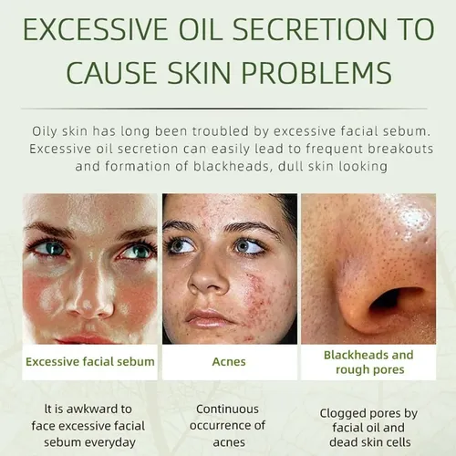 Crema Facial For Eliminar El Acné, Crema Hidratante