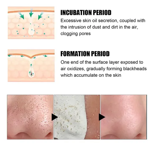 Eliminador De Pegatinas Dropshipping Nose Blackhead Ii