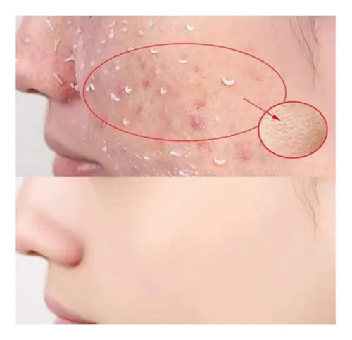 Exfoliante Facial En Gel Blanqueador, Exfoliante Facial Hidr