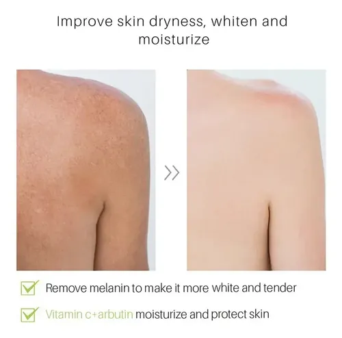 Crema Ácida For Manchas Kójicas E Dark A For El Rostro Y V