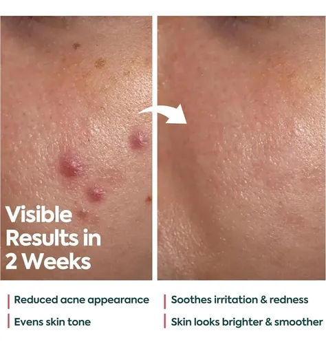 Crema Acne Facial 40 Ml Her Kozmetik Faceupskin