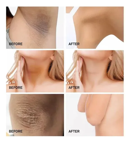 M* Crema Despigmentante Para Manchas, Vitíligo, Acné Y *xl