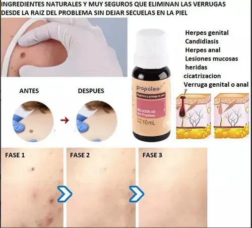 Anti Acne Elimina Granitos Puntos Negros Natural Y Saludable