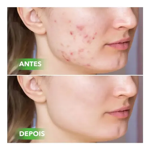 .sa Crema De Ácido Salicílico Z Para Eliminar Los Poros .hg