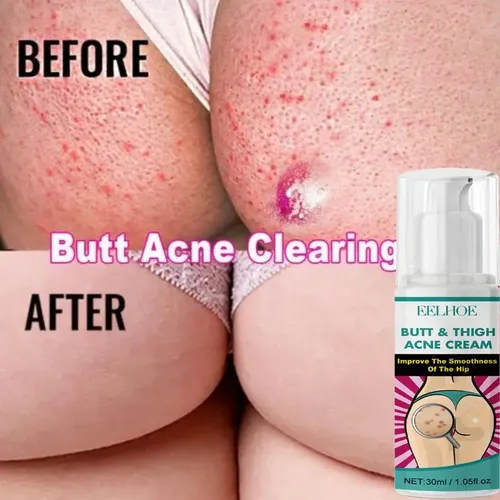 Crema For El Acné, Limpieza De Manchas Oscuras, Espinillas –