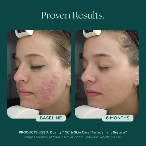 Crema Facial Para Acne Duality Xc Marini Skin Solutions