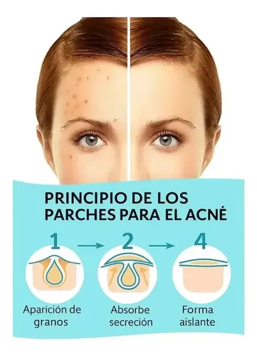 Kit De Parche Para Acne 72 Redondo Protectores Seca Granitos