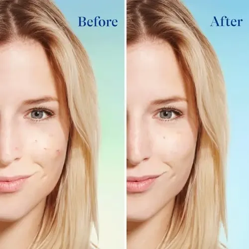 +jabón Facial Differin Acne Con Peróxido De Benzoilo Al 5%,  Acneica
