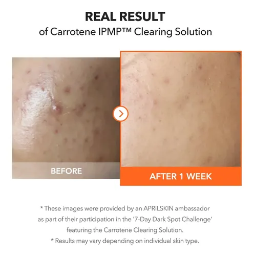 Aprilskin-solución Limpiadora Carrotene Ipmp. Acné-manchas.