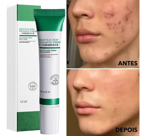 Crema De Ácido Salicílico Aa X Z Para Remoción De Poros Acné