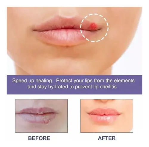 4parches Suavizantes For Herpes Labial Parche Curativo .
