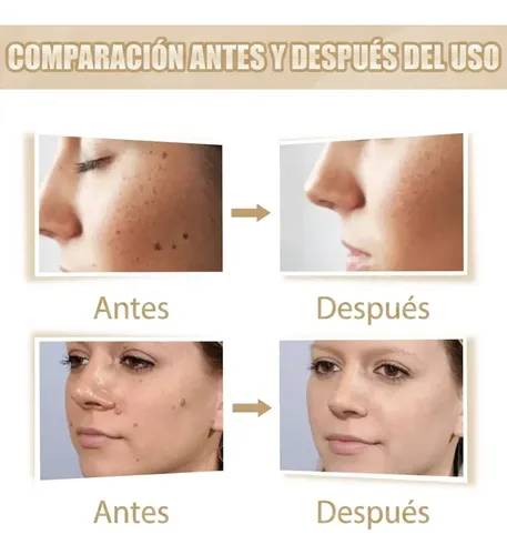 Lápiz Quitaverrugas Quitacallos Fácil Uso Resultados Visible