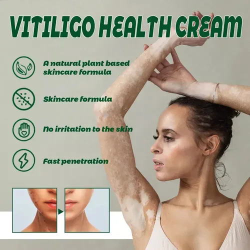 Cjw Tn 3 × Pomada Localizada Creme Vitiligo Branco M Para