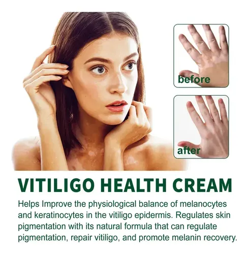 Cjw Tn 3 × Pomada Localizada Creme Vitiligo Branco M Para
