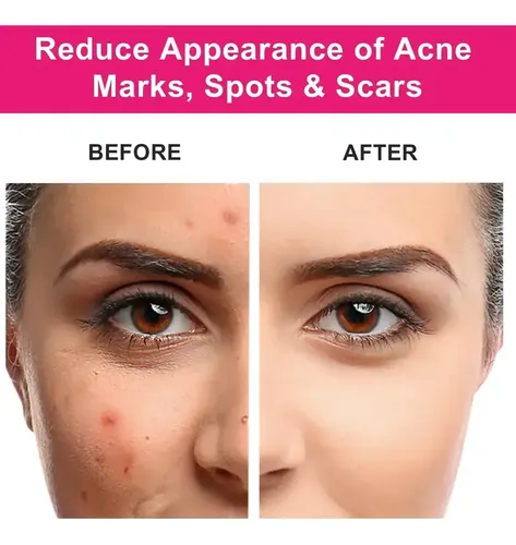 Aceite De Rosa Mosqueta Facial Reafirmante Rehidratante Puro