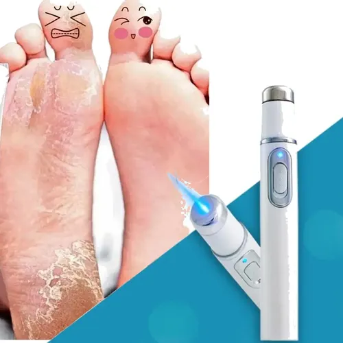 Laser Tratamiento Uñas Repara Onicomicosis Manos Pies Portab