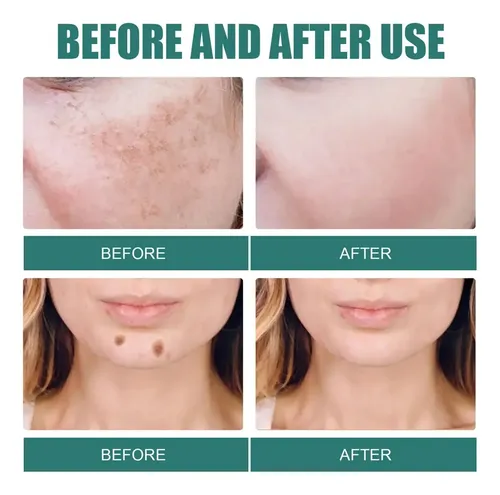 I Crema Iluminadora Facial Eelhoe Manchas Melasma Manchas Y