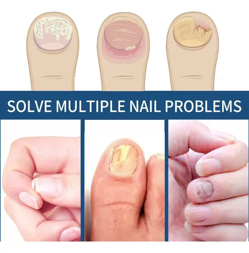 Parches Impermeables Para Reparar Uñas, Pegatinas Adhesivas