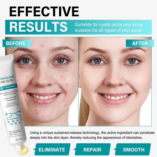 $crema Facial Antiacné 20 G, Hidratante, Reduce Los Granos D