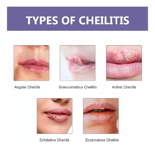 4parches Suavizantes For Herpes Labial Parche Curativo .