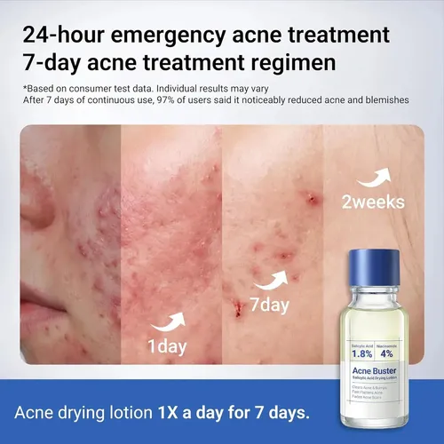 /crema Para Tratar La Acné, Ácido Salicílico Con Efecto Anti