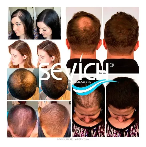 Pote Fibras Capilares Calvicie Entradas Pelo Cabello Debil