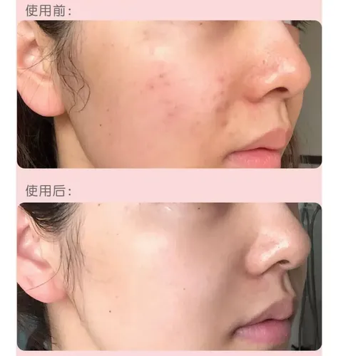 Parches Para Acne Patch X3 Planchas Rostro Elimina Granos