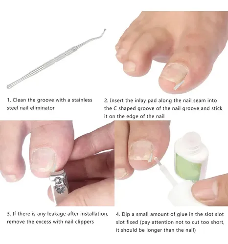 Mokasi Kit De Eliminación De Uñas Encarnadas, 50 Pcs