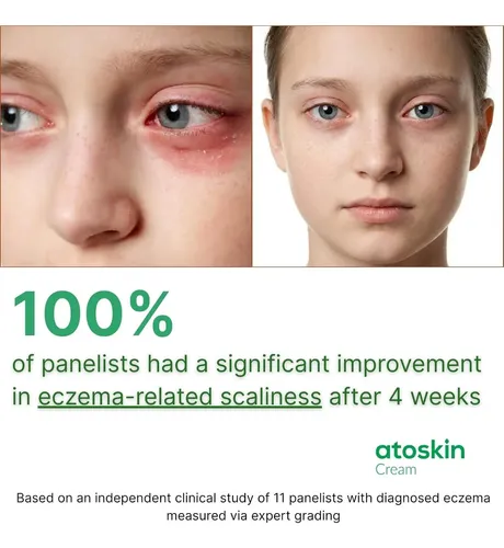 Crema Atoskin Para Eczema Y Dermatitis Con Manteca De