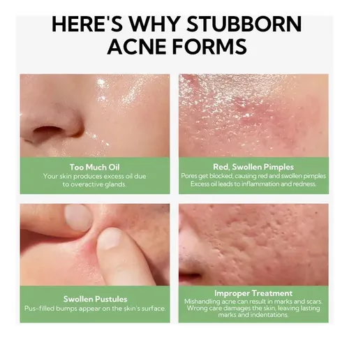 Lanbena Loción Secadora De Espinillas Y Acné Pimple Warrior Momento De Aplicación Noche Tipo De Piel Grasa