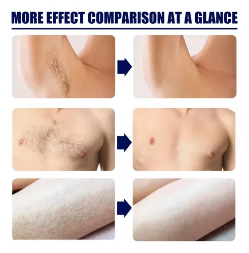 Crema De Depilación Permanente P 3 × – Removedor De Barba Yl