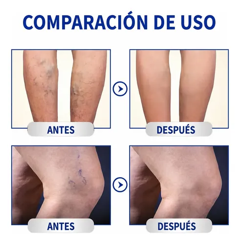 Crema Varices Estrías Descanso Piernas Post Jornada Larga