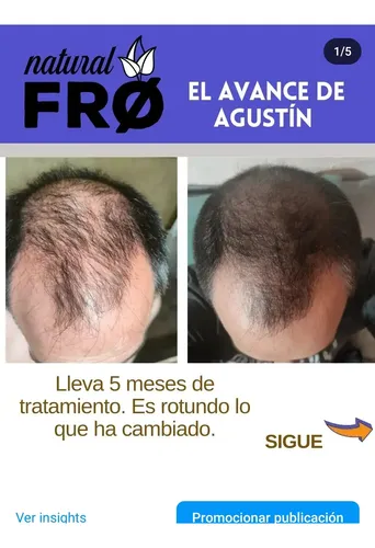 Loción Capilar Caida-crecimiento Capilar Naturalfro X 100ml
