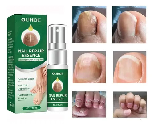 Spray Onicomicosis Tratamiento + Parche Cinta Ortesis X10 Neutra