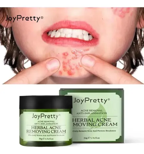 Crema Facial Eliminadora De Acné A Base De Hierbas Joypretty