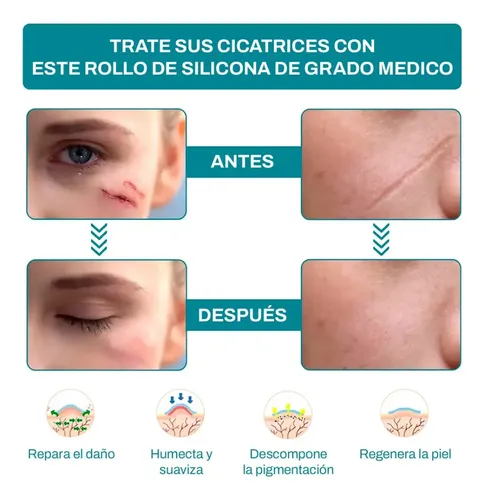 Cinta Cicatriz Cesarea Gaon Heridas Cuerpo Cirugia Queloide