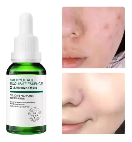 Sérum Facial Con Ácido Salicílico, Reduce Los Poros Y Contro